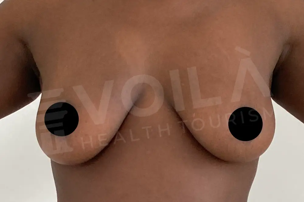 Impianto Mammario before and after — patient 11, before
