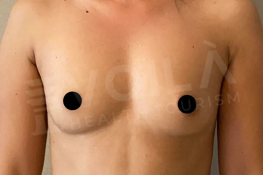 Impianto Mammario before and after — patient 12, before