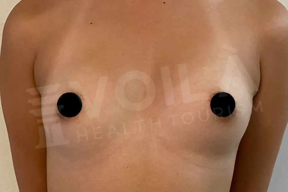 Impianto Mammario before and after — patient 14, before
