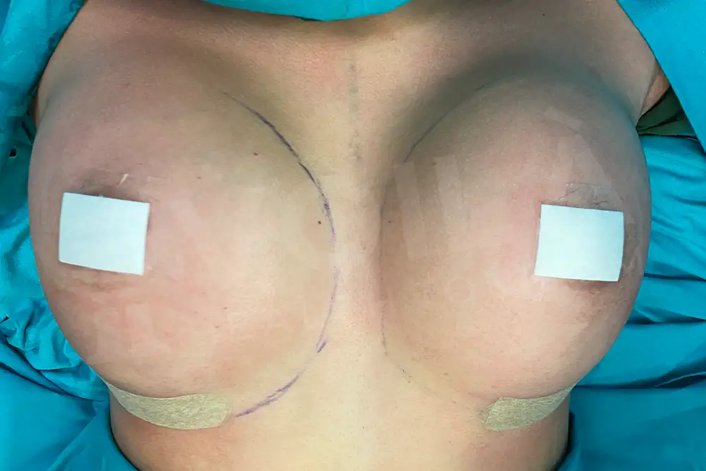 Impianto Mammario before and after — patient 18, after