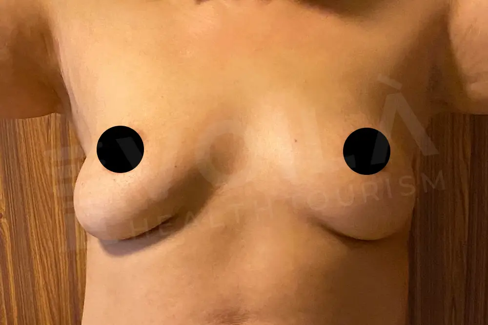 Impianto Mammario before and after — patient 20, before