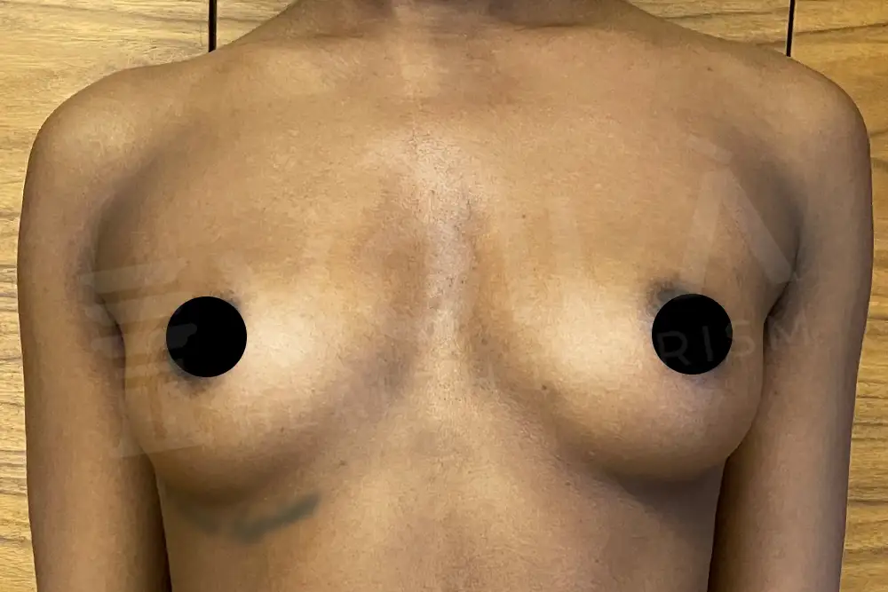 Impianto Mammario before and after — patient 21, before