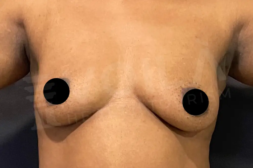 Impianto Mammario before and after — patient 29, before