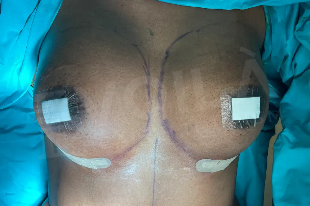 Impianto Mammario before and after — patient 29, after