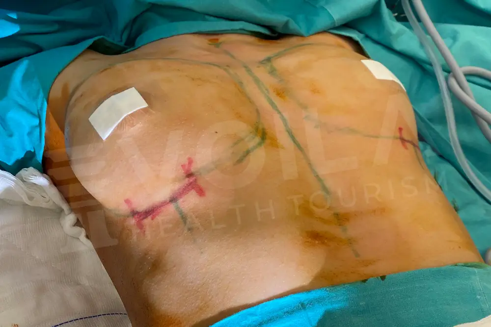 Impianto Mammario before and after — patient 3, before