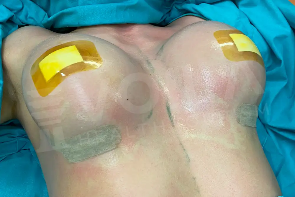 Impianto Mammario before and after — patient 3, after