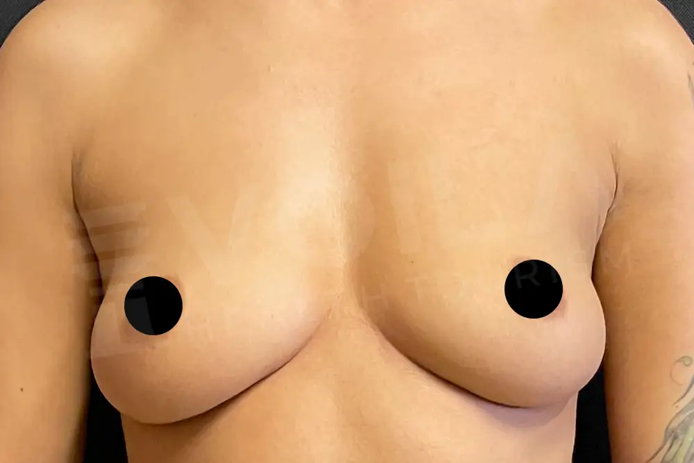Impianto Mammario before and after — patient 31, before