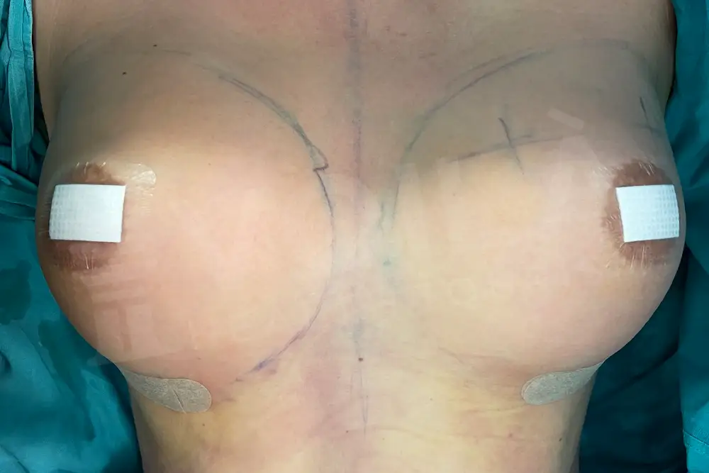 Impianto Mammario before and after — patient 32, after