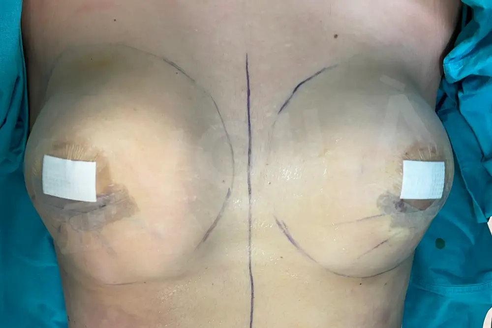 Impianto Mammario before and after — patient 33, after