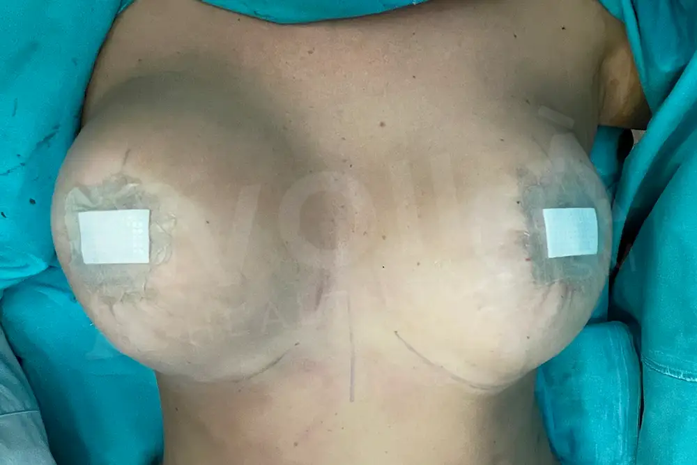 Impianto Mammario before and after — patient 34, after