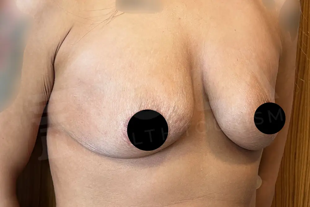 Impianto Mammario before and after — patient 36, before