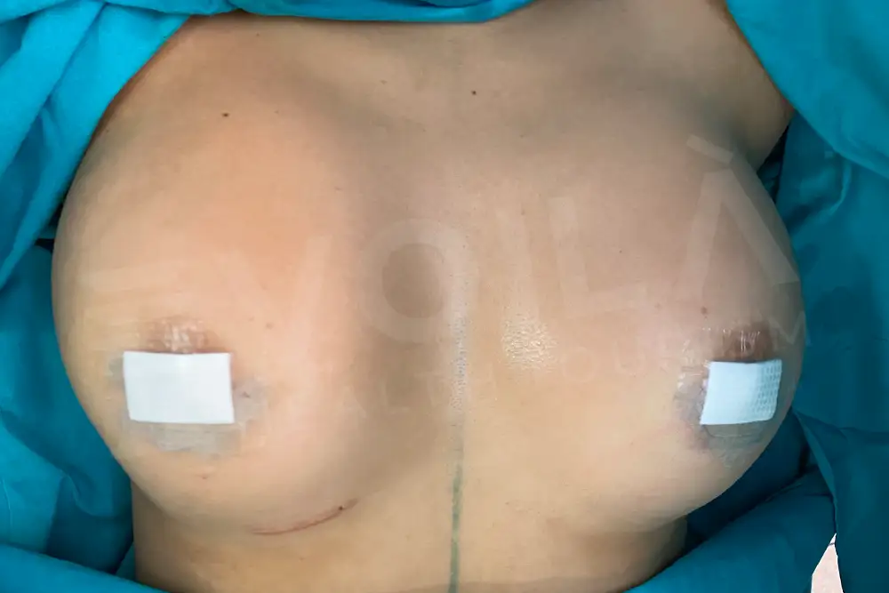 Impianto Mammario before and after — patient 39, after