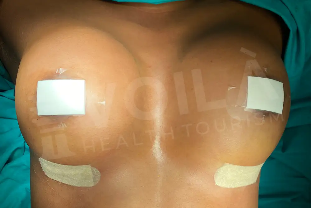 Impianto Mammario before and after — patient 5, after
