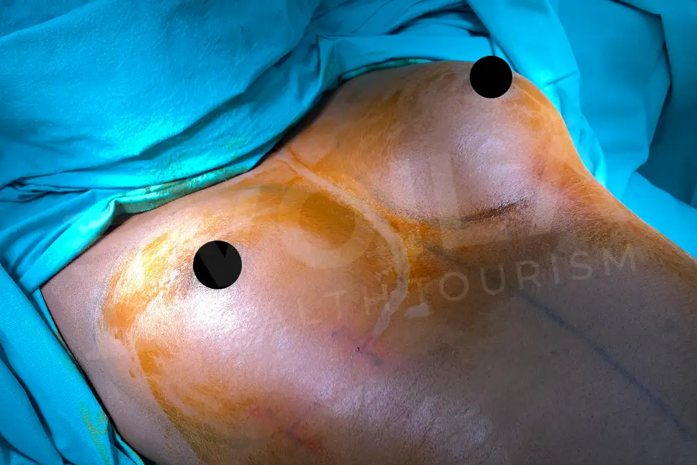 Impianto Mammario before and after — patient 8, before