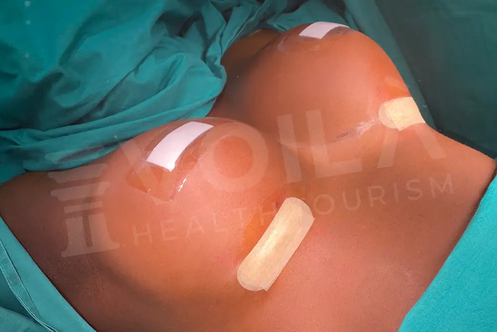 Impianto Mammario before and after — patient 8, after