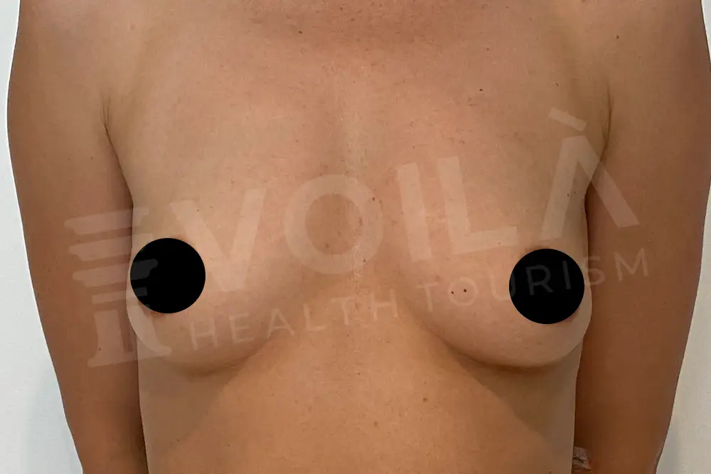 Impianto Mammario before and after — patient 9, before