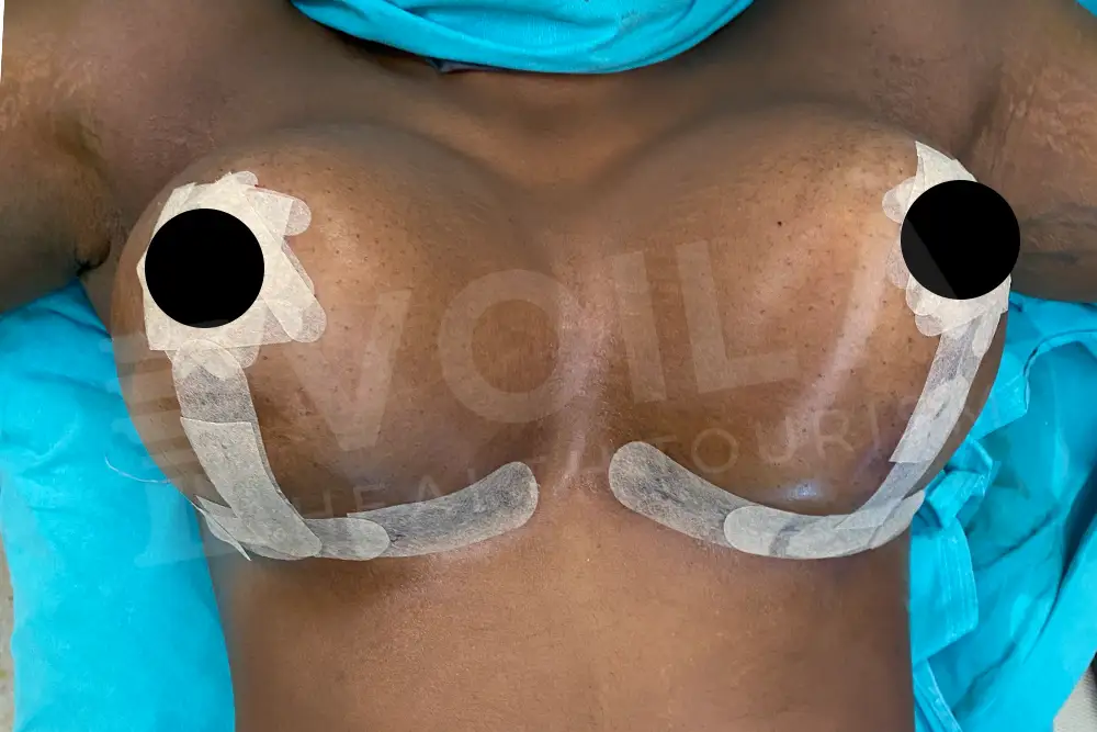 Lifting del Seno con Impianto before and after — patient 1, after