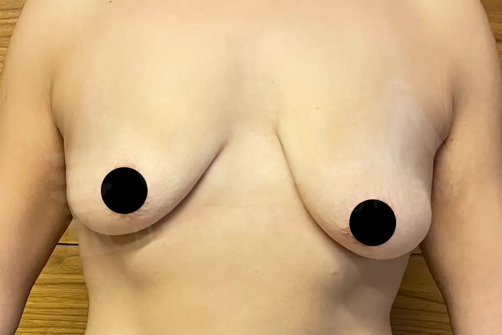 Lifting del Seno con Impianto before and after — patient 16, before