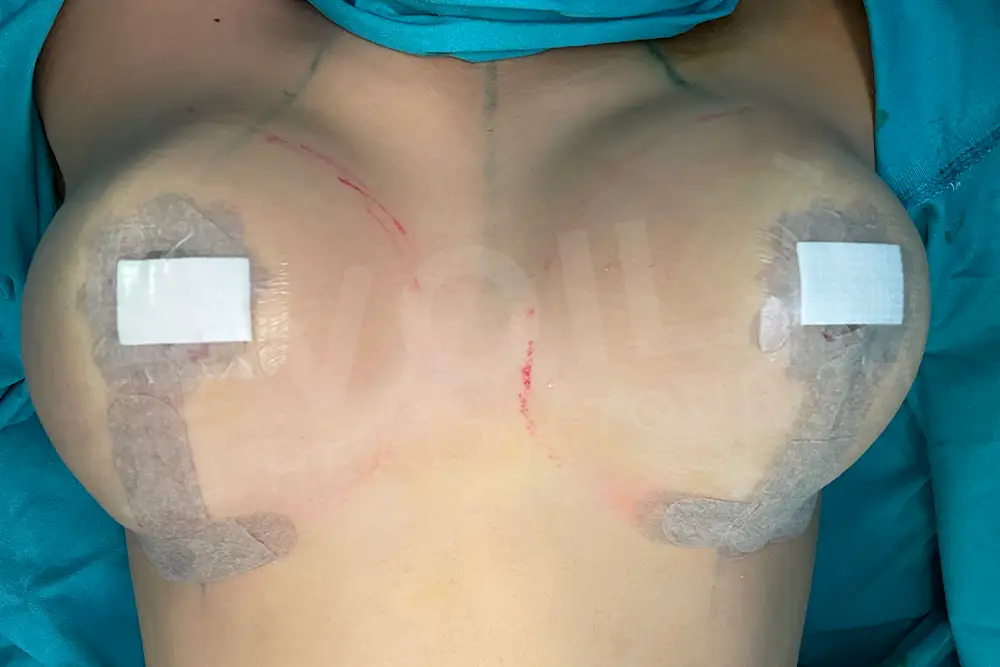 Lifting del Seno con Impianto before and after — patient 16, after