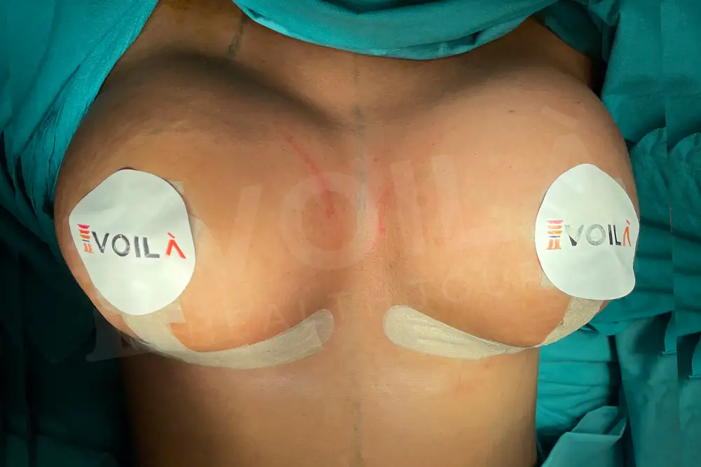 Lifting del Seno con Impianto before and after — patient 25, after