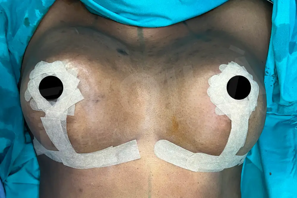 Lifting del Seno con Impianto before and after — patient 38, after