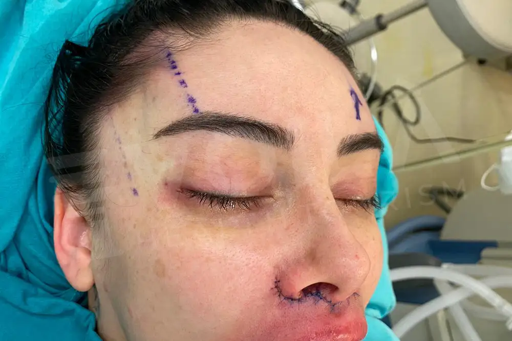 Cat Eye before and after — patient 1, before