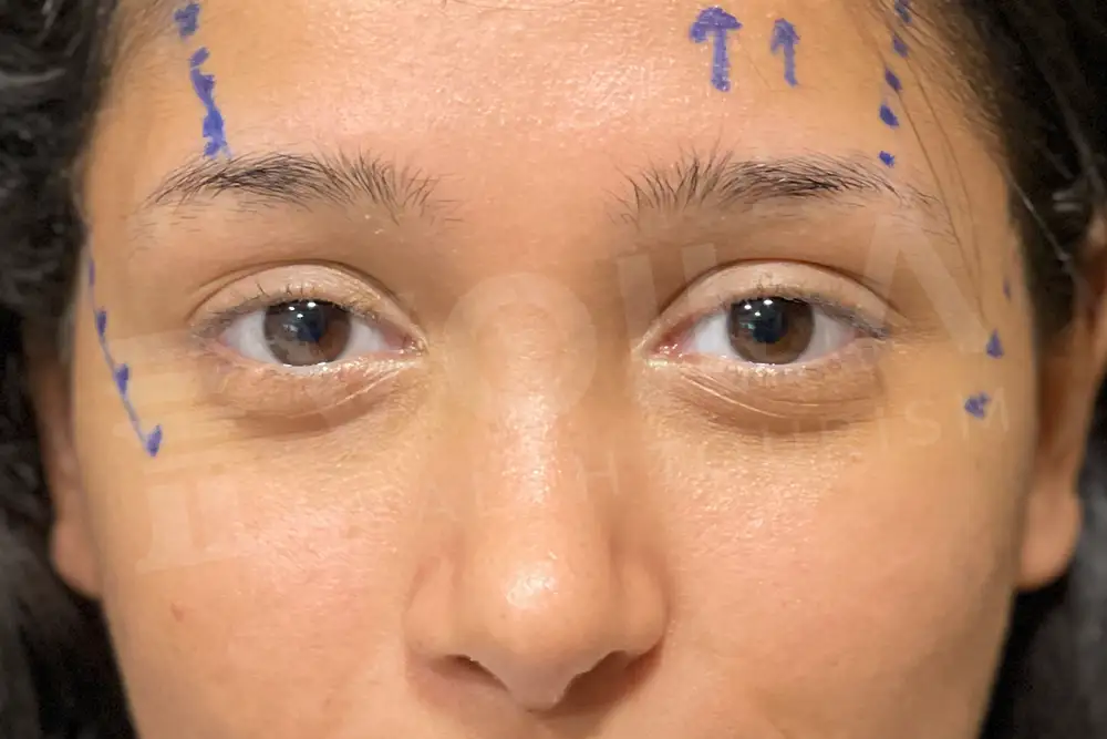 Cat Eye before and after — patient 2, before