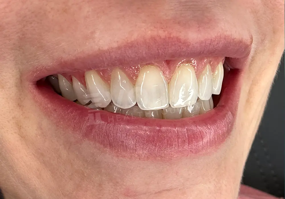 Lamina Veneer önce ve sonra — hasta 3, öncesi