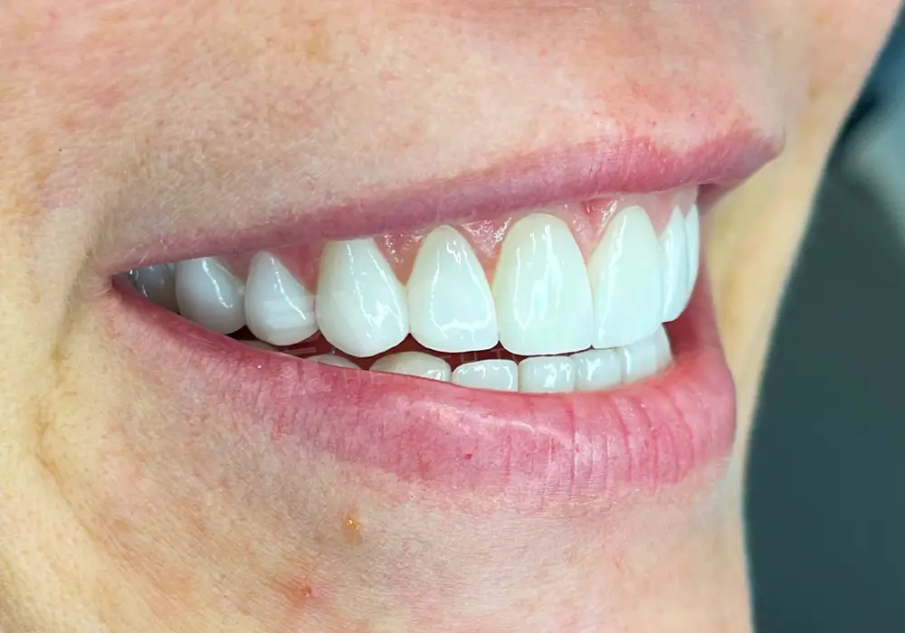 Lamina Veneer önce ve sonra — hasta 3, sonrası