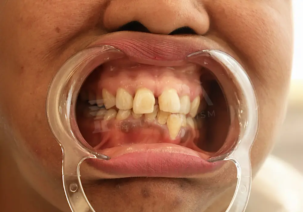 Zirkonium Kronen before and after — patient 1, before