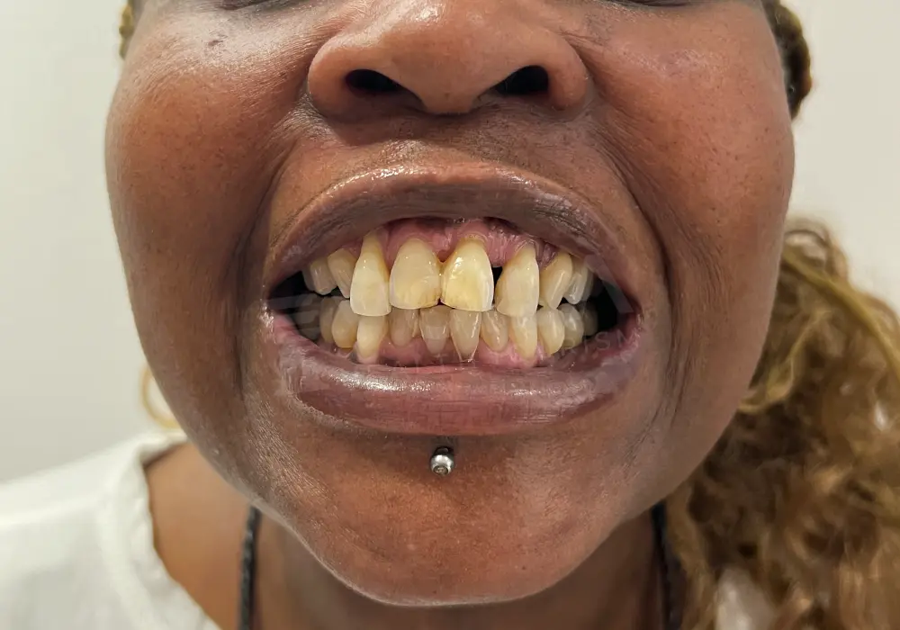 Zirkonium Kronen before and after — patient 2, before