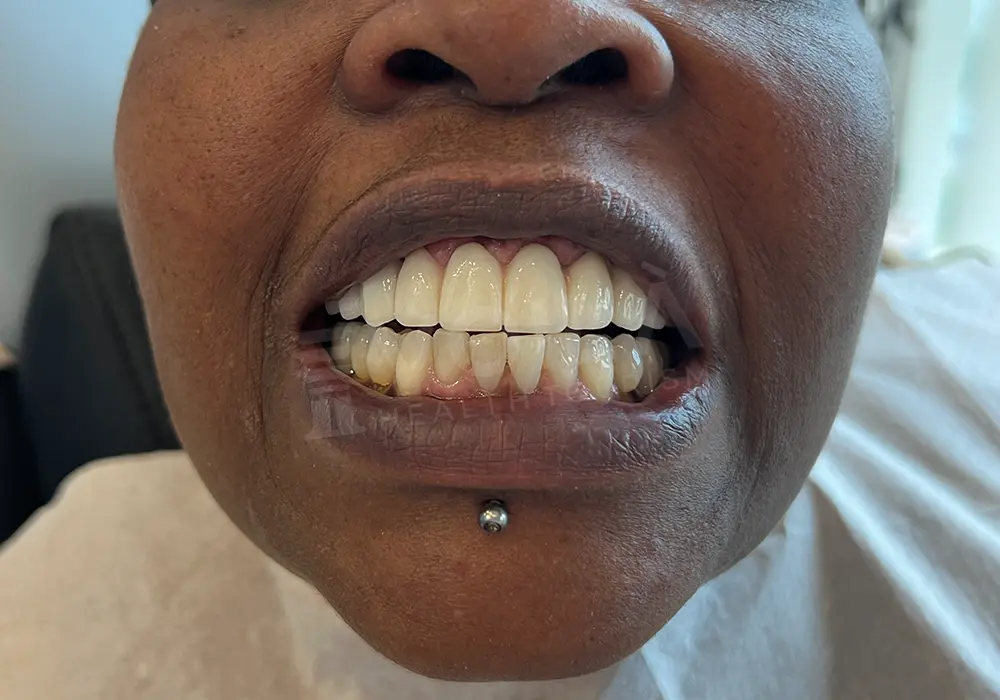 Zirkonium Kronen before and after — patient 2, after