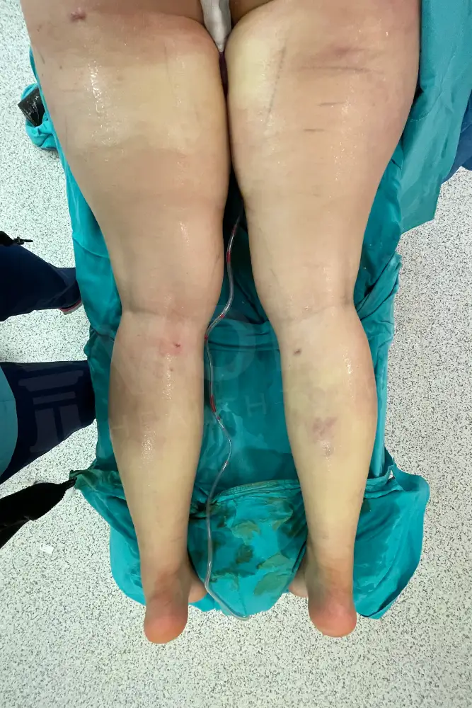 Bacak Liposuction önce ve sonra — hasta 10, sonrası