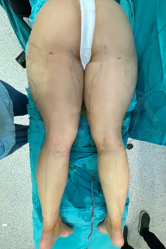 Bacak Liposuction önce ve sonra — hasta 11, sonrası