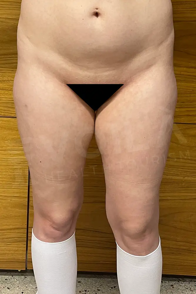 Bacak Liposuction önce ve sonra — hasta 4, öncesi