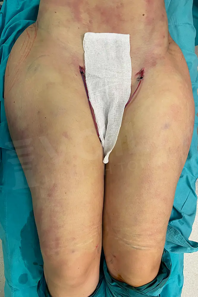 Bacak Liposuction önce ve sonra — hasta 5, sonrası