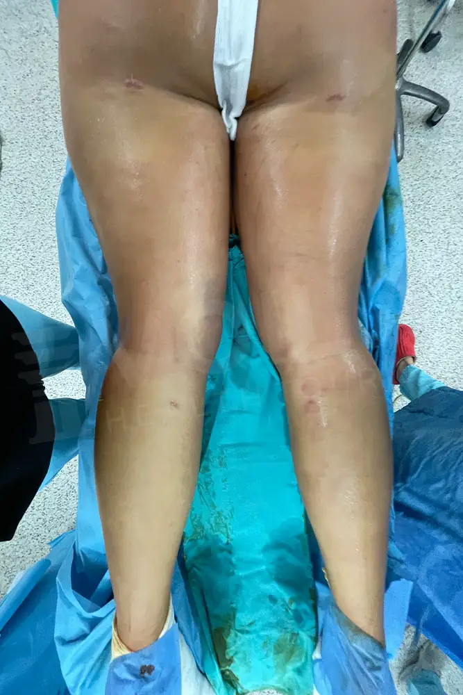 Bacak Liposuction önce ve sonra — hasta 8, sonrası