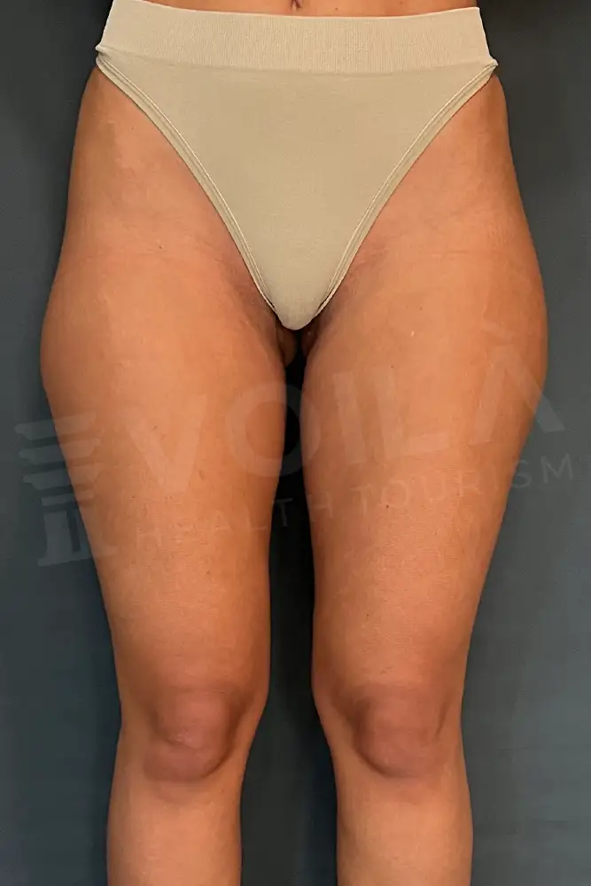 Bacak Liposuction önce ve sonra — hasta 9, öncesi