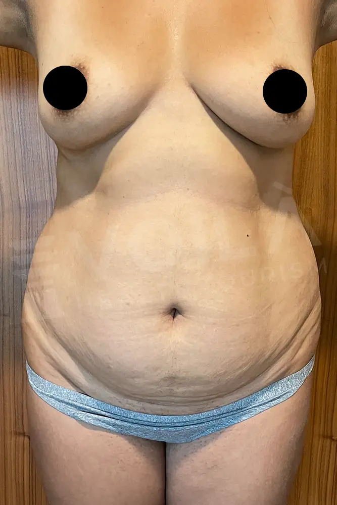Fettabsaugung before and after — patient 10, before