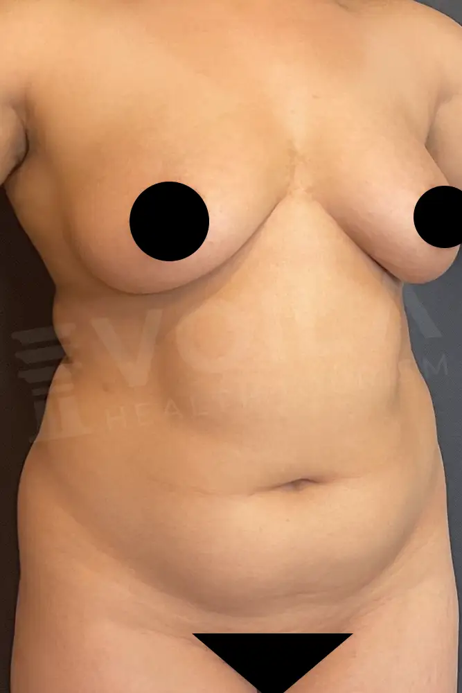 Fettabsaugung before and after — patient 18, before