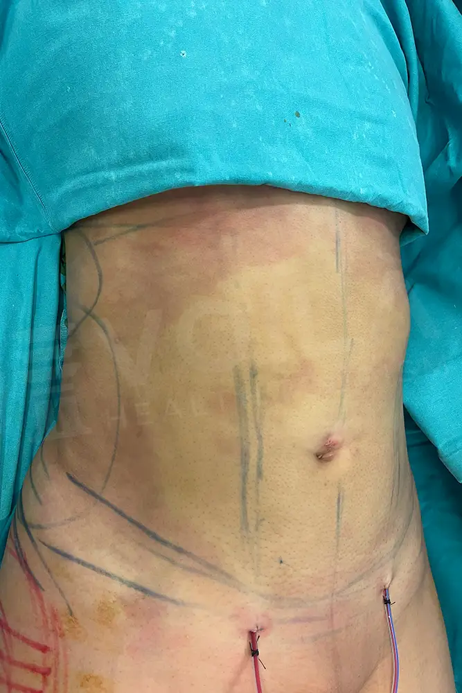 Fettabsaugung before and after — patient 18, after