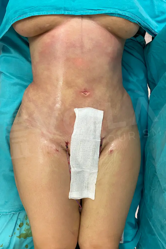 Fettabsaugung before and after — patient 3, after