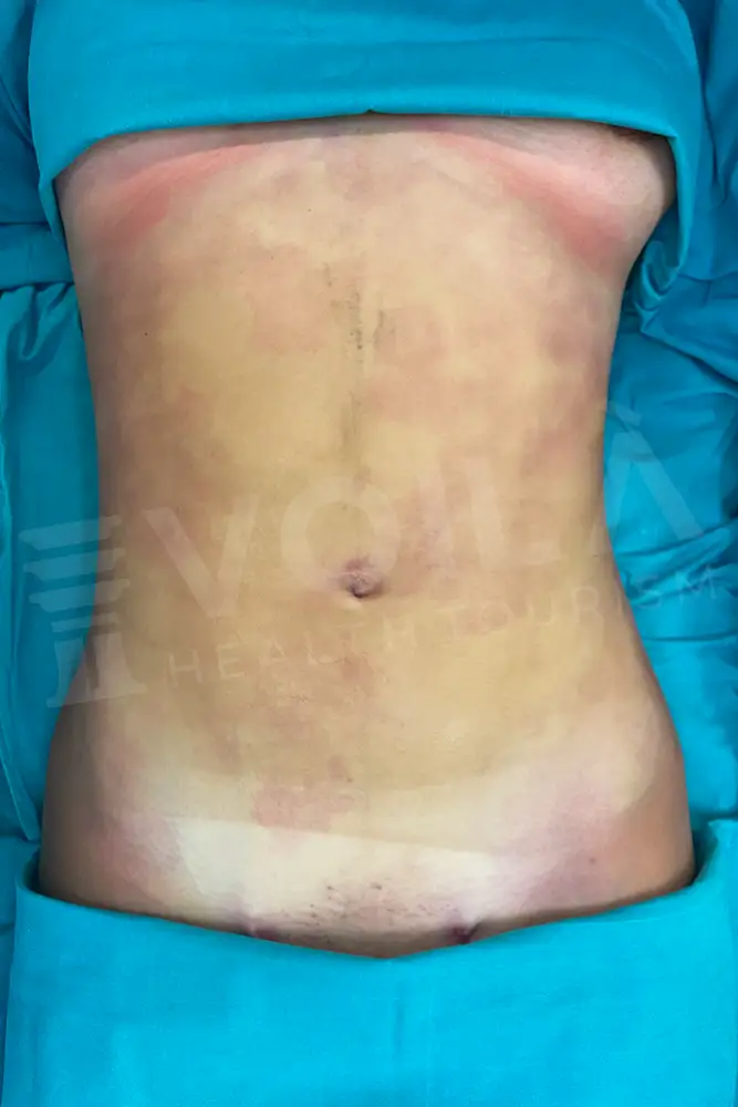 Fettabsaugung before and after — patient 6, after