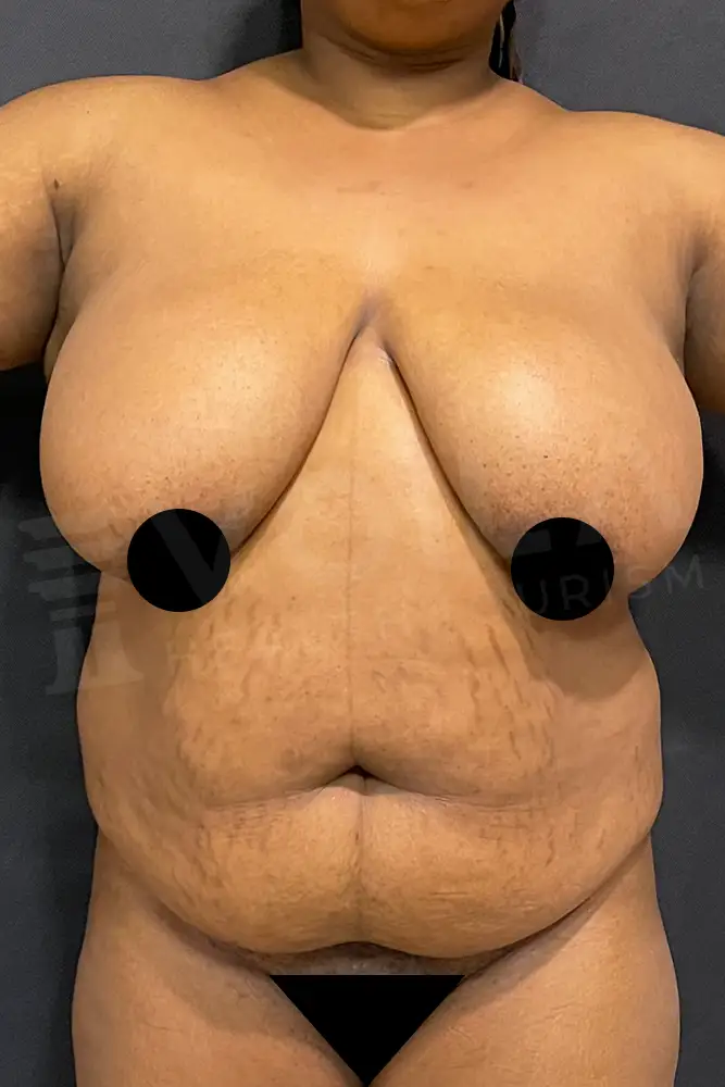 Mommy Makeover önce ve sonra — hasta 15, öncesi