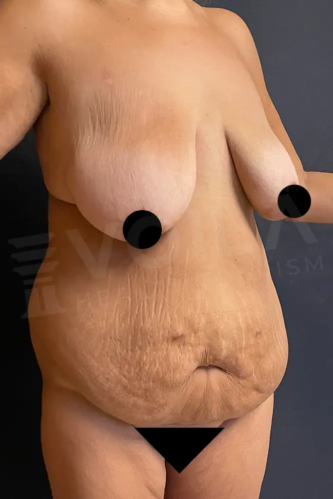 Mommy Makeover önce ve sonra — hasta 17, öncesi