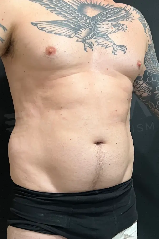 Cirugía de Six Pack before and after — patient 5, before