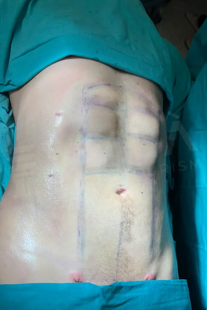 Cirugía de Six Pack before and after — patient 5, after