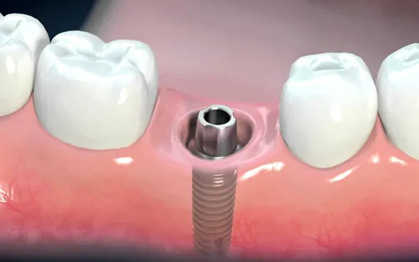 Proceso de osteointegración