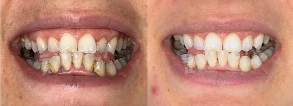 Assessing Suitability for Teeth Whitening
